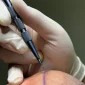 Sapphire FUE Hair Transplant Revolutionizing Hair Restoration 85x85